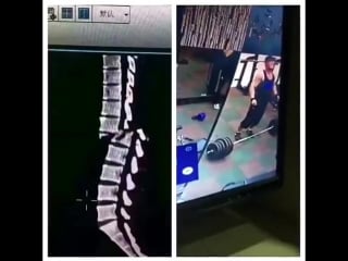 Перелом позвоночника