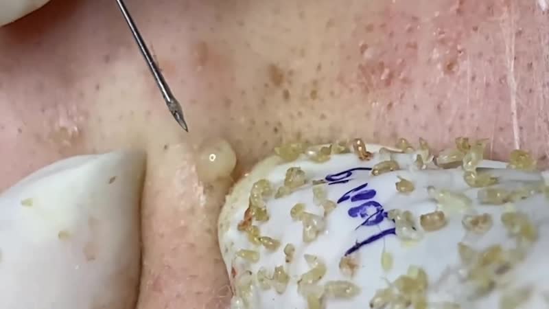 Чистка лица черные точки, угри, забитые поры