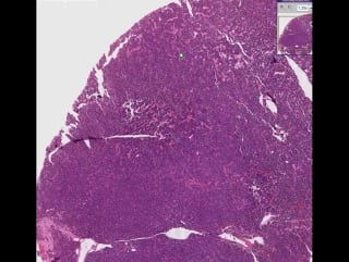 Lung small cell carcinoma