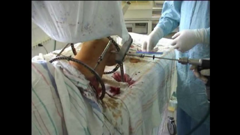 Остеосинтез бедра