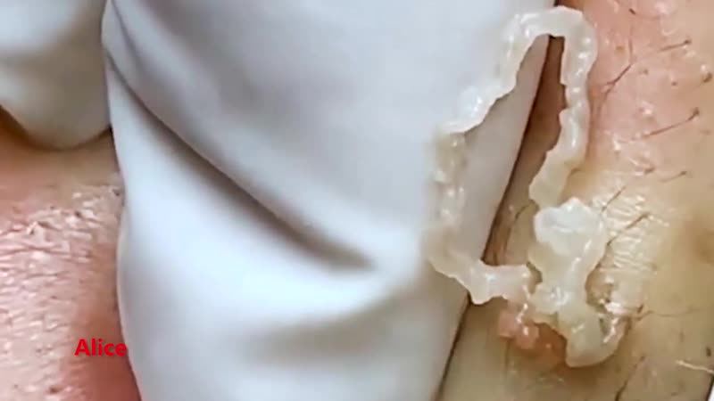Кисты porn video – Выдавливание кисты