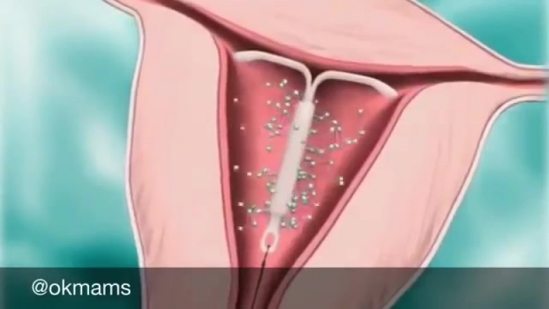 Внутриматочная спираль (вмс)