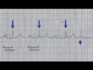 Ecg case 6 collapse with angina