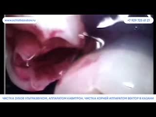 – чистка зубов air flow в казани
