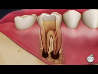 Terapia canalare devitalizzazione