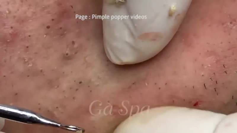 Черные точки, воспаленные прыщи