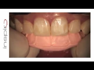 Inspiro direct restoration bio esthetics predictable layering technique