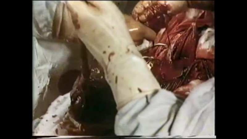 Кесарево сечение, анестезиологическое пособие при кесаревом сечении © cesarean section