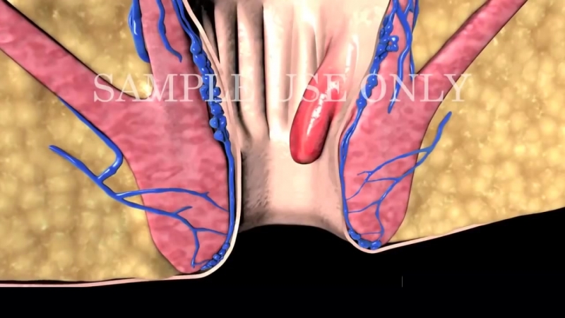 Лечение геморроя степени геморроя