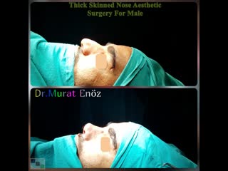 Thick skinned nose aesthetic surgery for male istanbul turkey rhinoplasty men