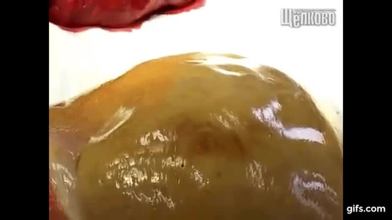 Здоровая печень и печень алкоголика