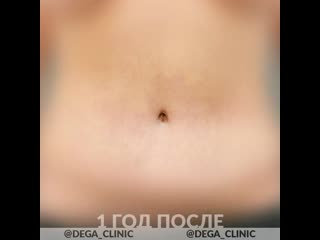Пупок после абдоминопластики