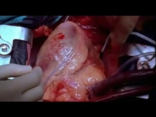 Создание искусственного кровообращения