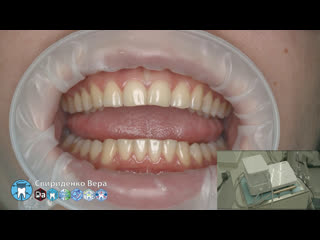 Professional oral hygiene dte pt 5 acteon kerr hawe dentsply (fhd multistream)