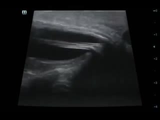 Протезирование мужских половых органов