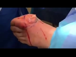 Огромный абсцесс