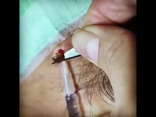 Удаление родинки