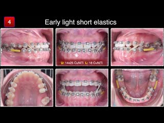 Chris chang solving anterior crossbite with elastics ортодонтия