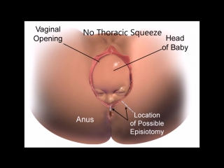 Neonatal respiration rds,ttn,mas