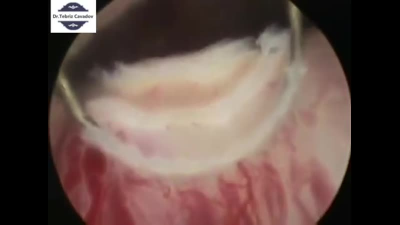 Tur nədir? – trans uretral rezeksiya (prostat vəzin lazerlə qapalı əməliyyatı – plazmakinetik tur)