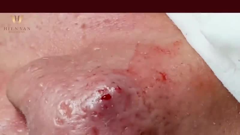 Вскрывание большого подкожного прыща на носу