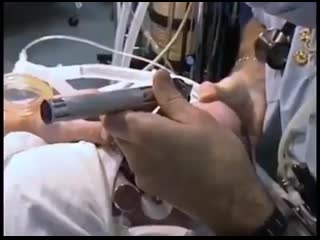 Интубация трахеи младенца