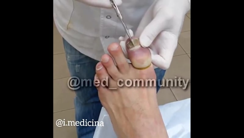 Удаление ногтя, пораженного онихомикозом