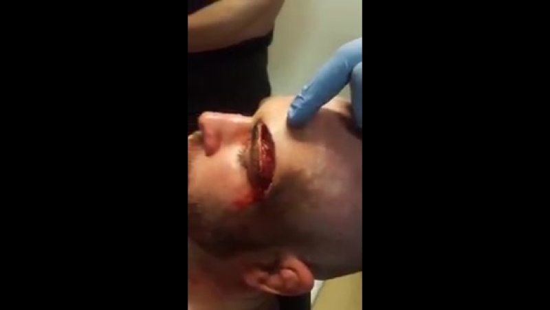 1xbet ужасное рассечение