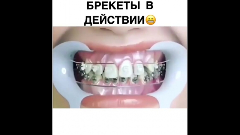 Брекеты porn video – Брекеты в действии