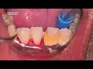 Удаление зубного камня