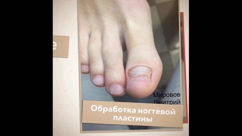 Протезирование ногтевых пластин