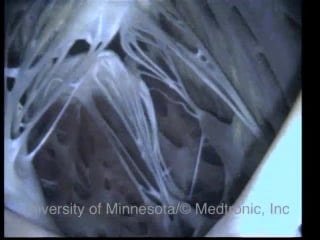 Heart0009 functional right ventricle posterior papillary muscle