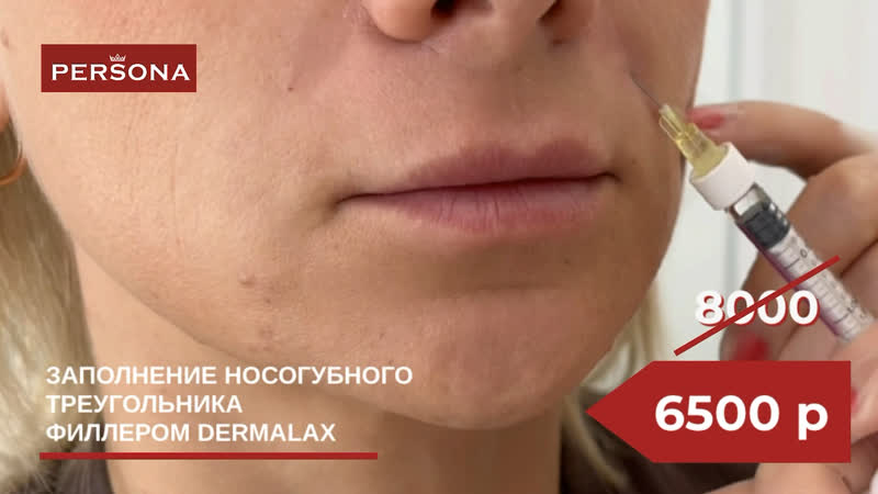 Заполнение носогубных складок филлером (dermalax)