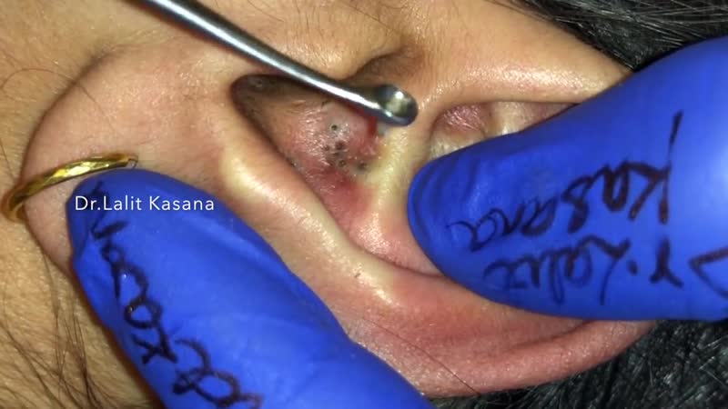 Черные точки в ушах от kasana