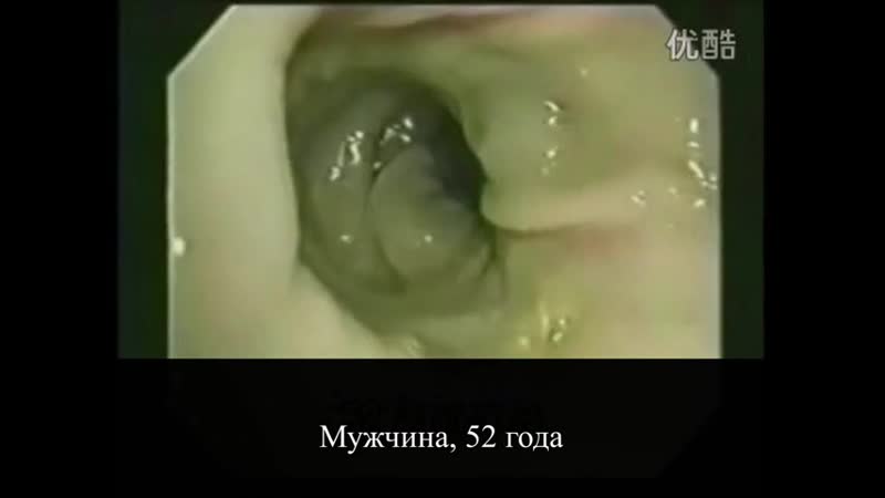 Колоноскопия видео