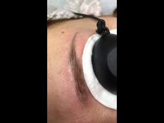 Лазерное удаление татуажа другого мастера