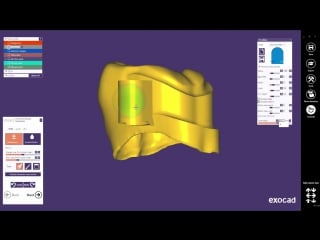 Exocad quick guide new attachment feature