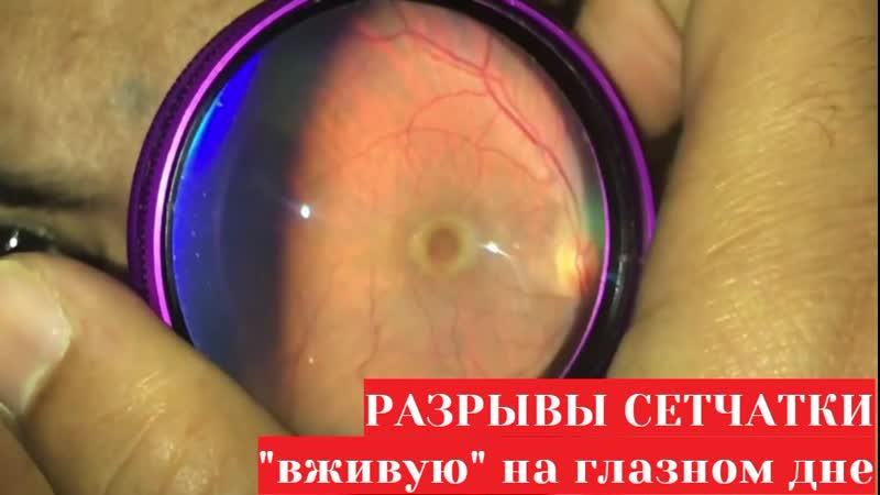 Разрывы сетчатки "вживую" на глазном дне при офтальмоскопии узнай что внутри твоего глаза!