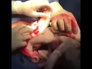 Кесарево сечение