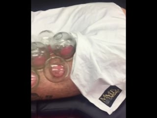 Chinese cupping therapy