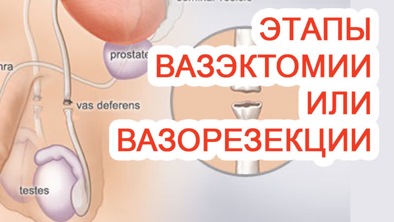 Этапы вазэктомии