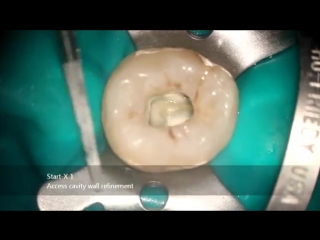 First mandibular molar endodontic acces cavity (1)