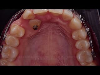 Surgical orthodontic insertion of the canine into the arch