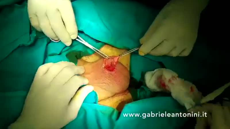 Вазэктомия презентация доктора габриэле антонини