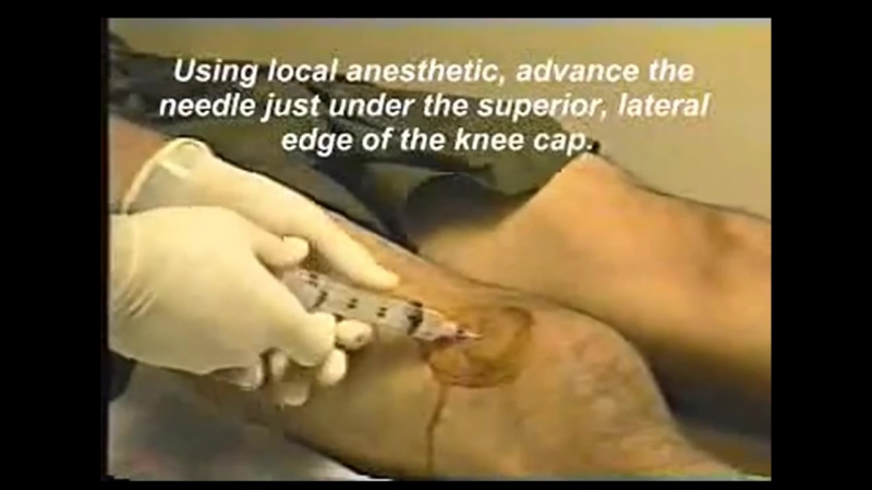 Пункция коленного сустава