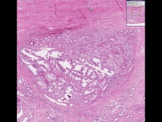 Prostate adenocarcinoma (gleason grade 1)