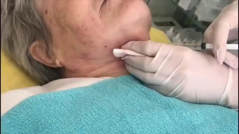 Липолитики лицо