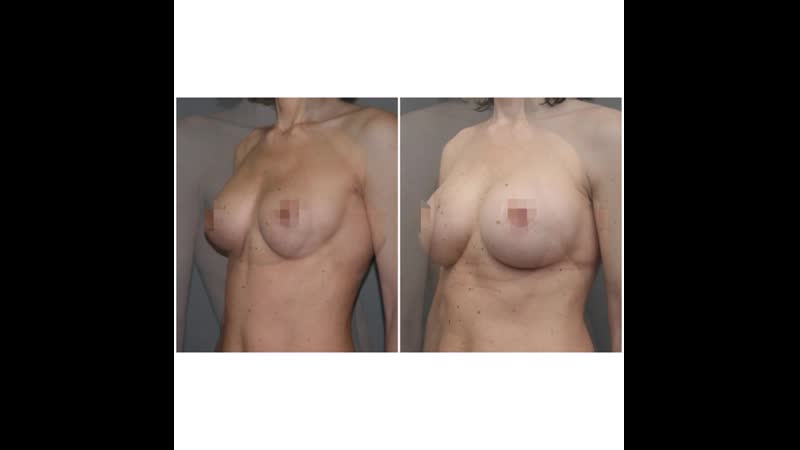 Замена имплантов повторная маммопластика