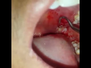 Абсцесс в полости рта