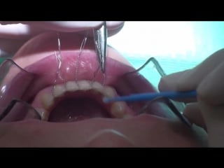 Lingual fixed retainers in clinical routine direct technique c metallic ties ортодонтия